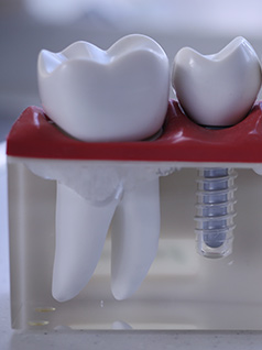 Dental Implant
