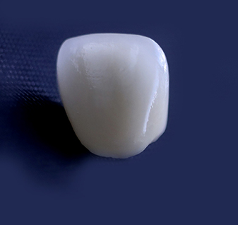 All porcelain crowns